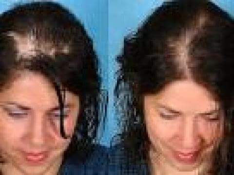 Hair Scalp Treatment