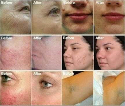 Urticaria Treatment